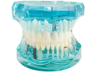 Стоматологическая модель с зубами, кариесом, имплантом, периодонтитом, камнем - изображение 3