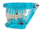 Стоматологическая модель с зубами, кариесом, имплантом, периодонтитом, камнем - изображение 10