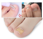Наклейки тейпы от Врастания Ногтя при деформации ногтевой пластины для коррекции ногтя набор пластырей 50 шт (AN)20461 2ф - изображение 3